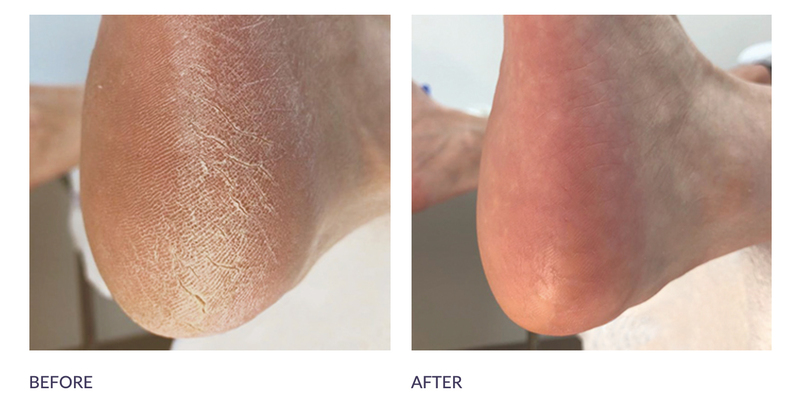 Dry Skin, Heel & Elbow Moisturizer, Intensive Foot Care Treatment Callus  Remove | eBay
